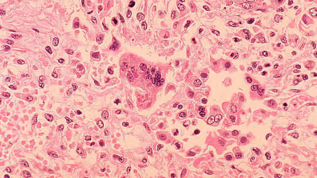 Measles Outbreaks Spread In U.S. 
