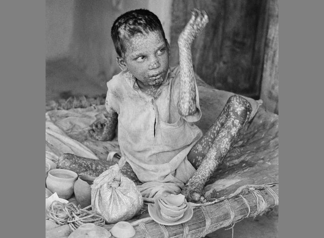 Child Infected with Measles 