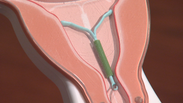 IUD-OVARIAN-CANCER-5-PKG.transfer_frame_1490.png 