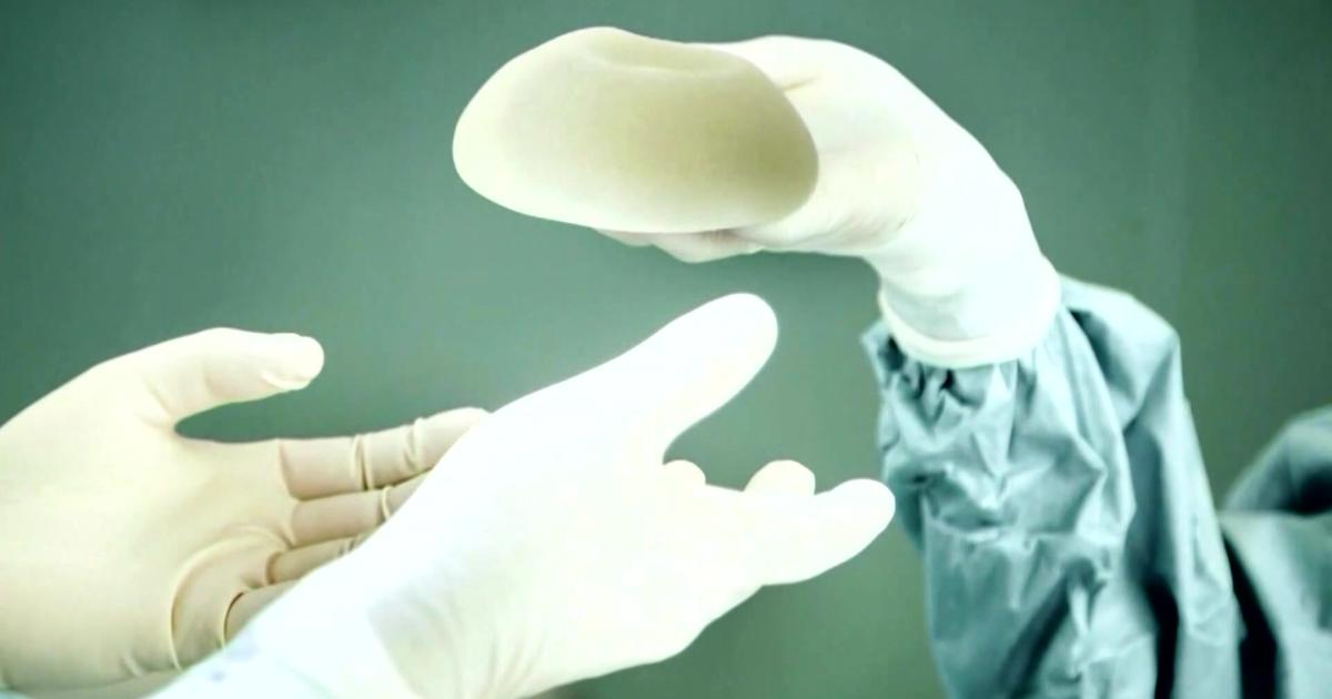 Breast Implant Recall: What Should You Do If You Have Allergan Recalled