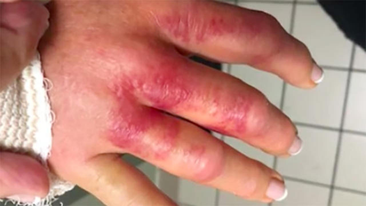 Dislocated Fingers, Finger Abscesses, Infections & Injuries - YouTube