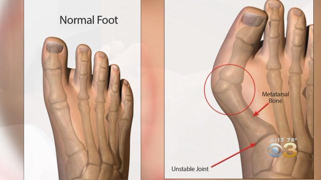 bunion.jpg 