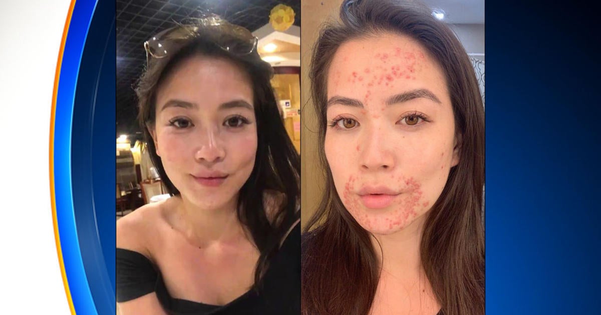 CBS4's Frances Wang Brings Awareness To Skin Condition In Order To Help ...