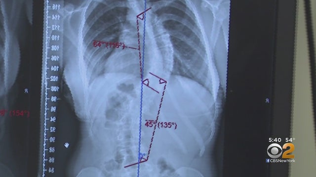 scoliosis-surgery.jpg 
