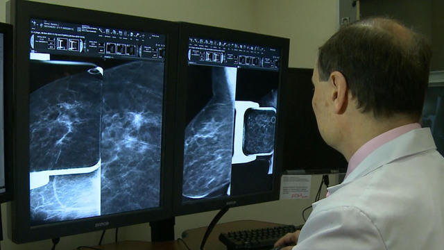 1204-ctm-mprmammograms-werner-1988510-640x360.jpg 