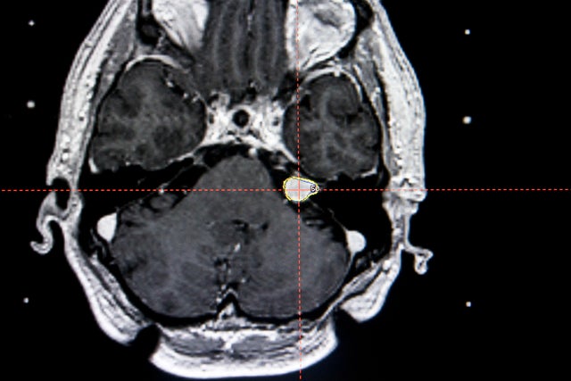 Acoustic Neuroma, Mri 