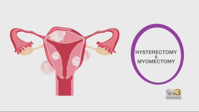 Hysterectomy.jpg 