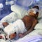 Addressing America's high premature birth rate