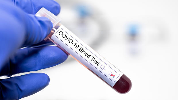 COVID-19 coronavirus positive blood sample diagnosed in hospital testing generic 