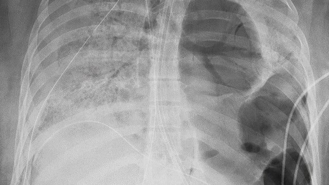 Virus Outbreak Lung Transplant 