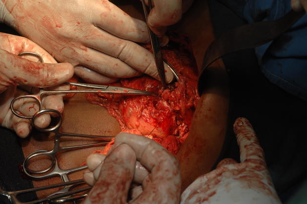Surgeon cutting through abdomen, so as to remove enlarged spleen 