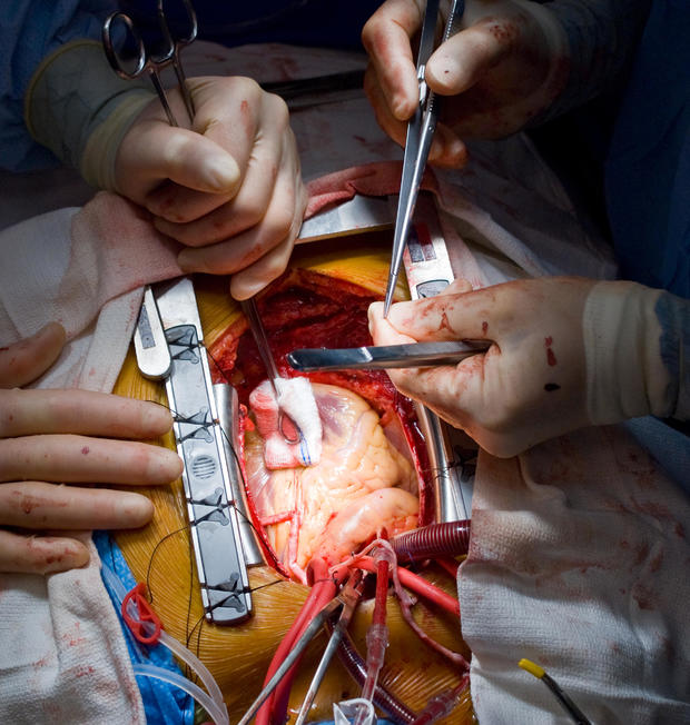 Heart Surgery CABG 