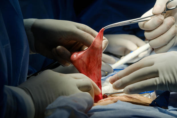Repair of intestine during abdominal surgery of inguinal hernia 