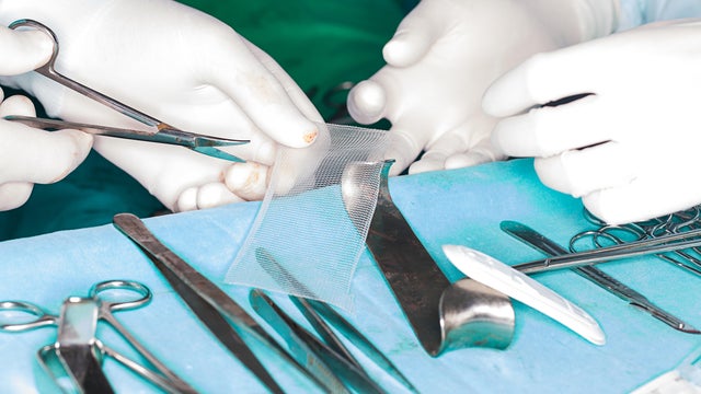 Surgical Mesh 