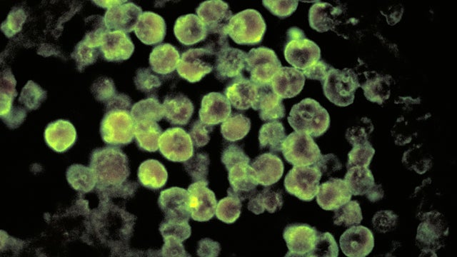 Amebic meningoencephalitis 
