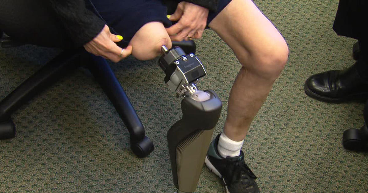Everything You Need To Know Before Getting a Prosthetic Leg-LuxMed Protez