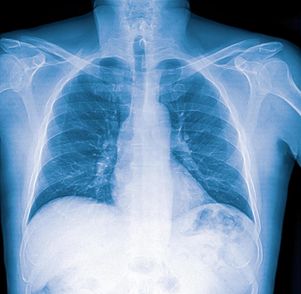X-ray image of lung with pneumonia 