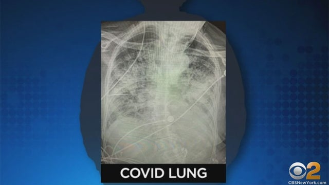 covid-lung.jpg 