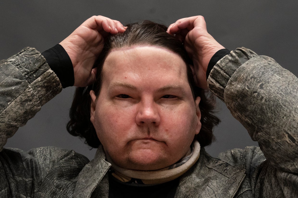 "You got a new chance at life": Recipient of extremely rare face and