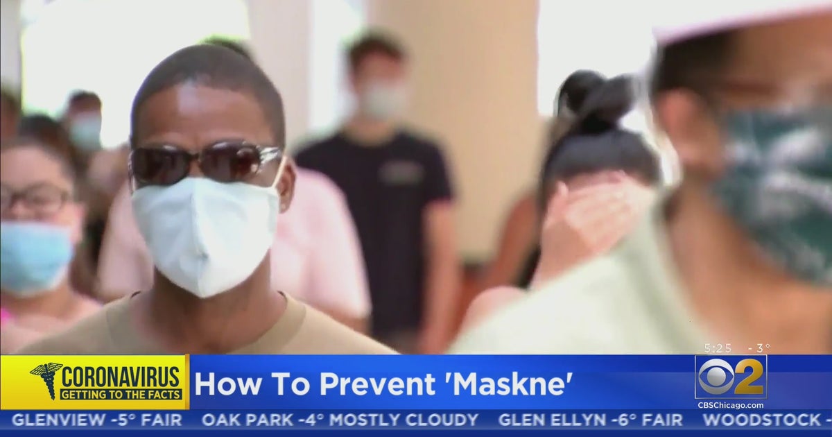 Expert Gives Tips To Avoid 'Maskne' - CBS Chicago
