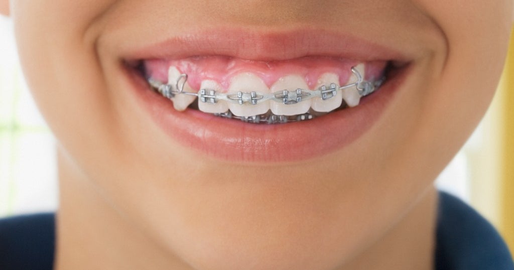 Orthodontist Kept Children In Braces Longer Than Necessary