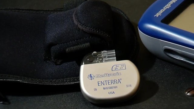 gastric-pacemakerrr.jpg 