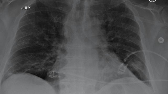 Chris Dellinger lungs 