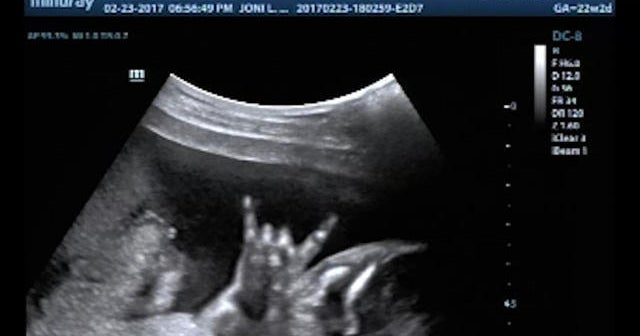 Baby flashes "rock on" sign during ultrasound CBS News