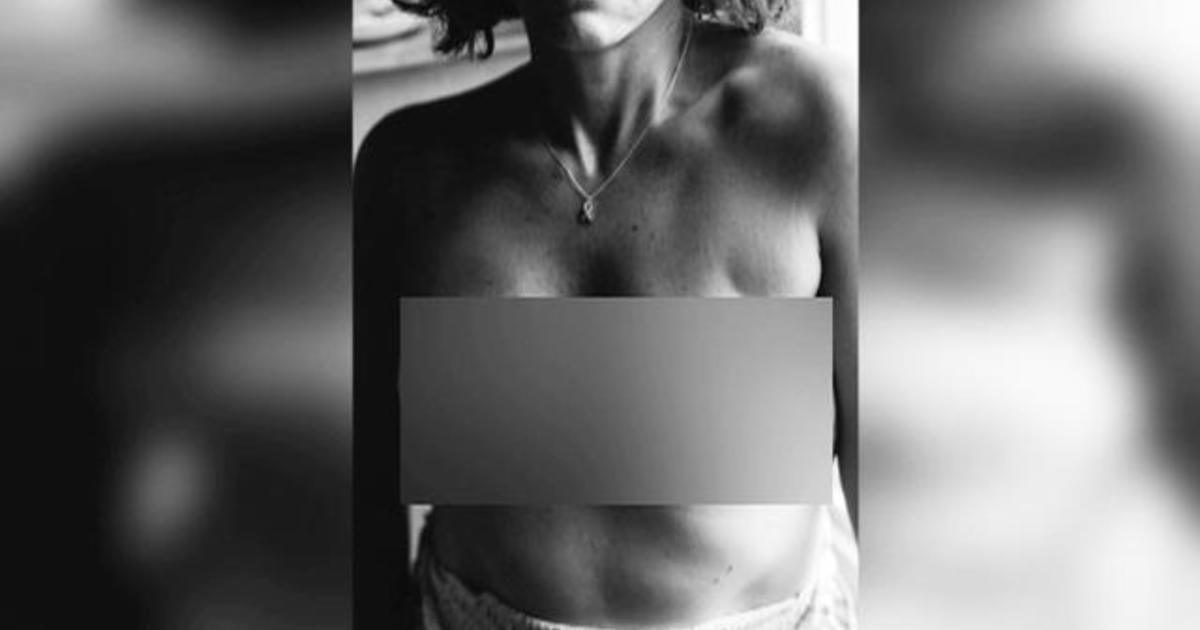 Allison Snare diagnosed with breast cancer shares topless photos  post-mastectomy