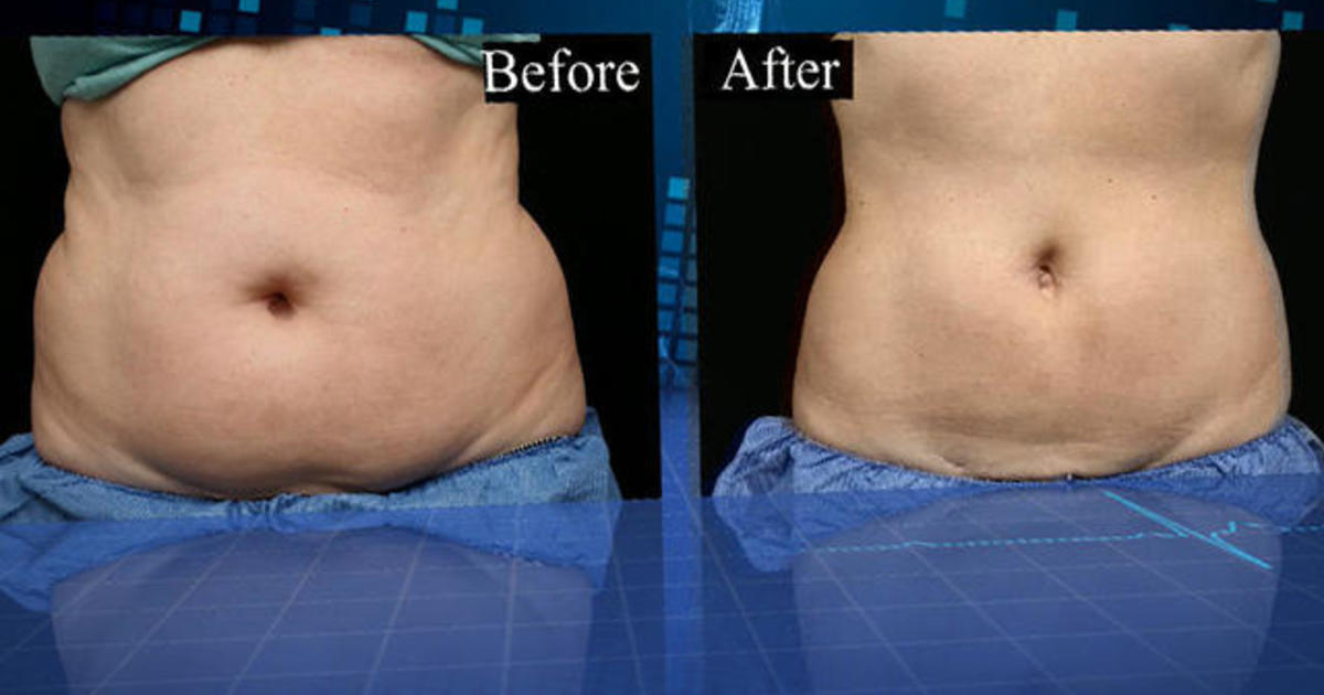 CoolSculpting: remove fat and slim down without surgery - CBS News