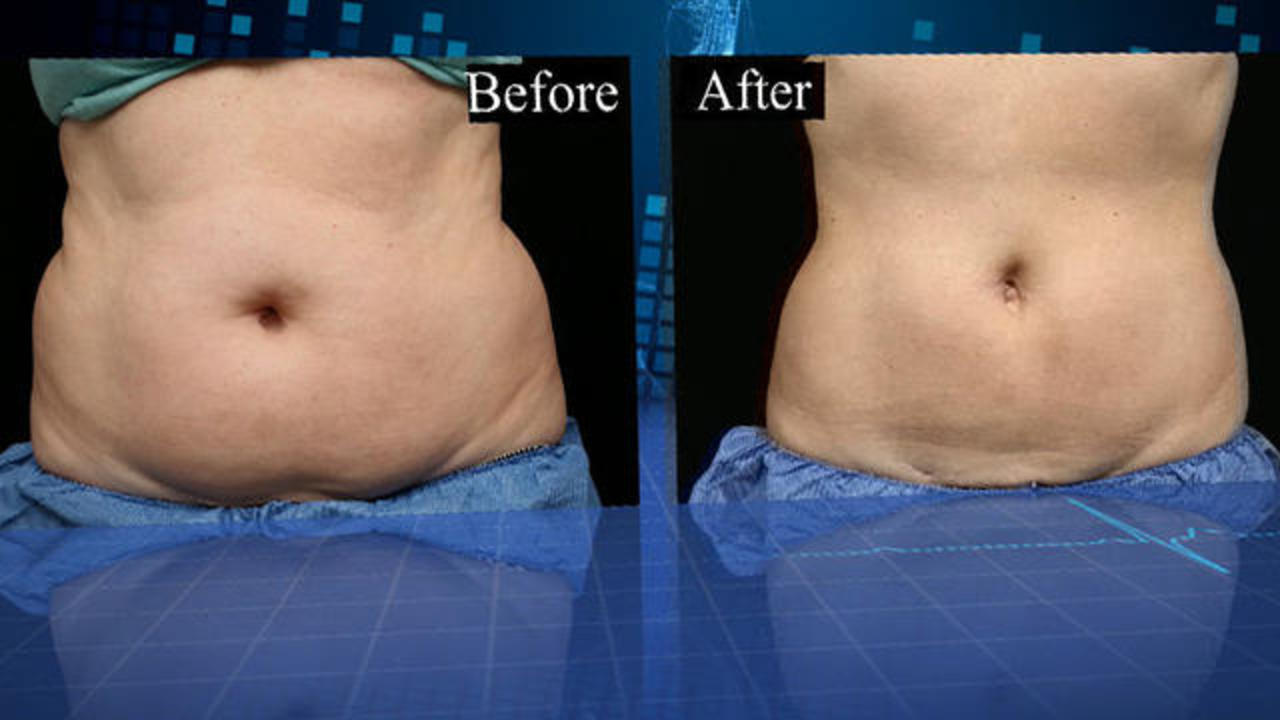 Sculpting a Smaller Waist with CoolSculpting Before & After Photos