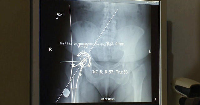 AMA: Regional anesthesia offers faster recovery for hip surgery - CBS News