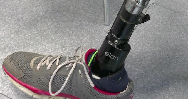 New prosthetic limbs provides sensation and mobility CBS News