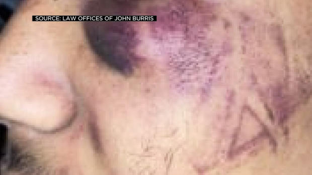 Photo Showing Injuries to Devin Carter, Stockton Teen Beaten During Arrest in 2020 