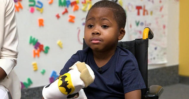 Meet Zion, the first child to get a double hand transplant CBS News