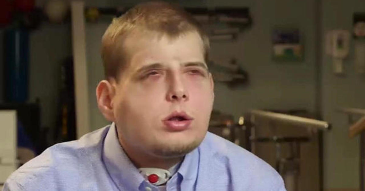 Firefighter Receives Extensive Facial Transplant Surgery Cbs News 8562