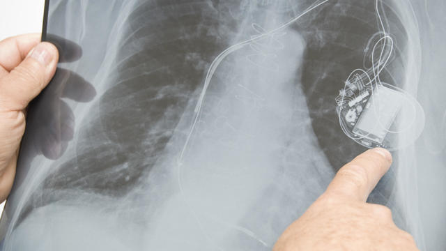 Doctor Examining Human Lungs and Pacemaker 