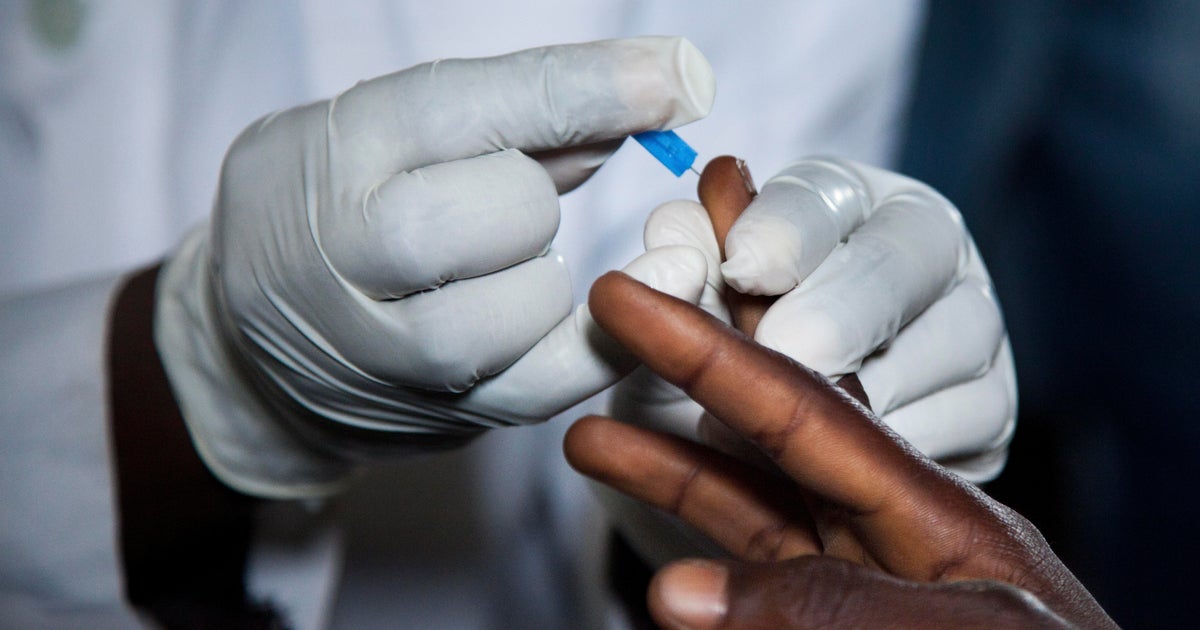 Annual new HIV infections in the U.S. down 73% since 1980s, CDC ...