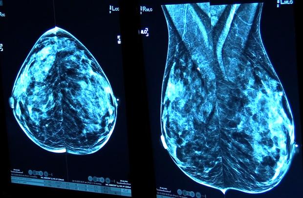 mammogram still1 