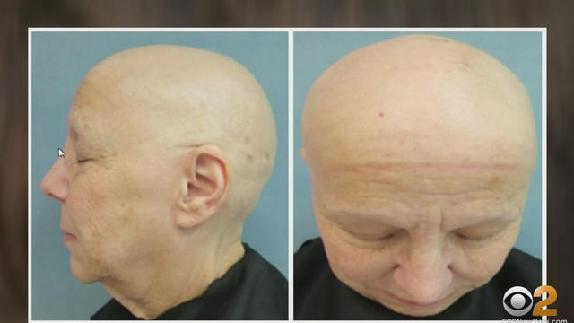 Alopecia-drug.jpg 