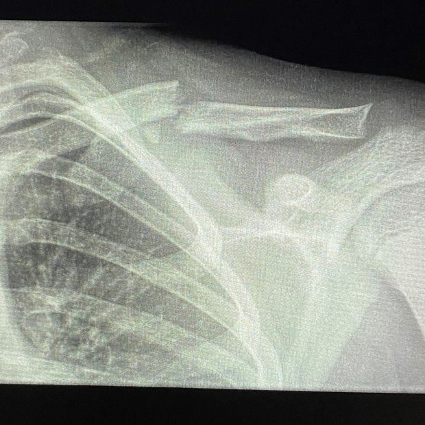 Skier collsion injury (Eagle Sheriff) 