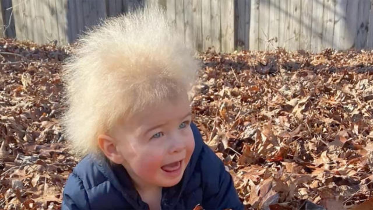 Boy has uncombable hair syndrome - CBS News