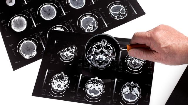 Dementia bran scan research 