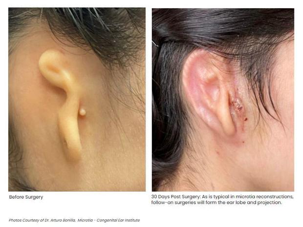 3dbio-printed-ear-before-and-after.jpg 