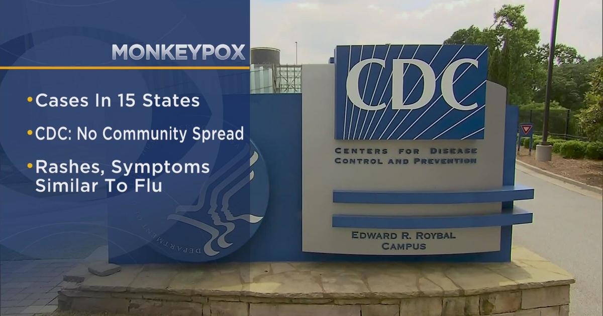 15 states, including Illinois, have monkeypox cases, according to federal health officials