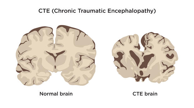Chronic Traumatic Encephalopathy CTE before and after comparison of normal brain and CTE brain 