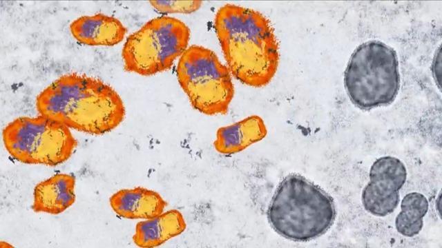 cbsn-fusion-over-7000-monkeypox-cases-reported-in-us-thumbnail-1180059-640x360.jpg 