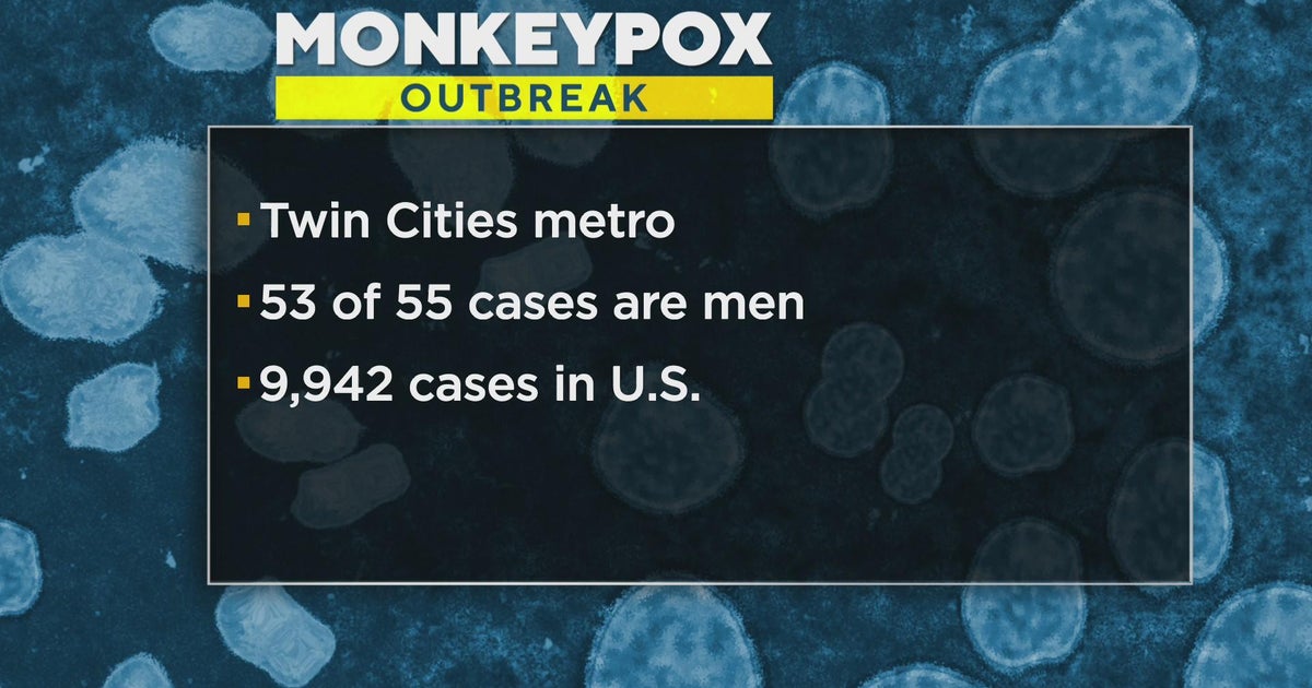 55 cases of monkeypox confirmed in Minnesota - CBS Minnesota