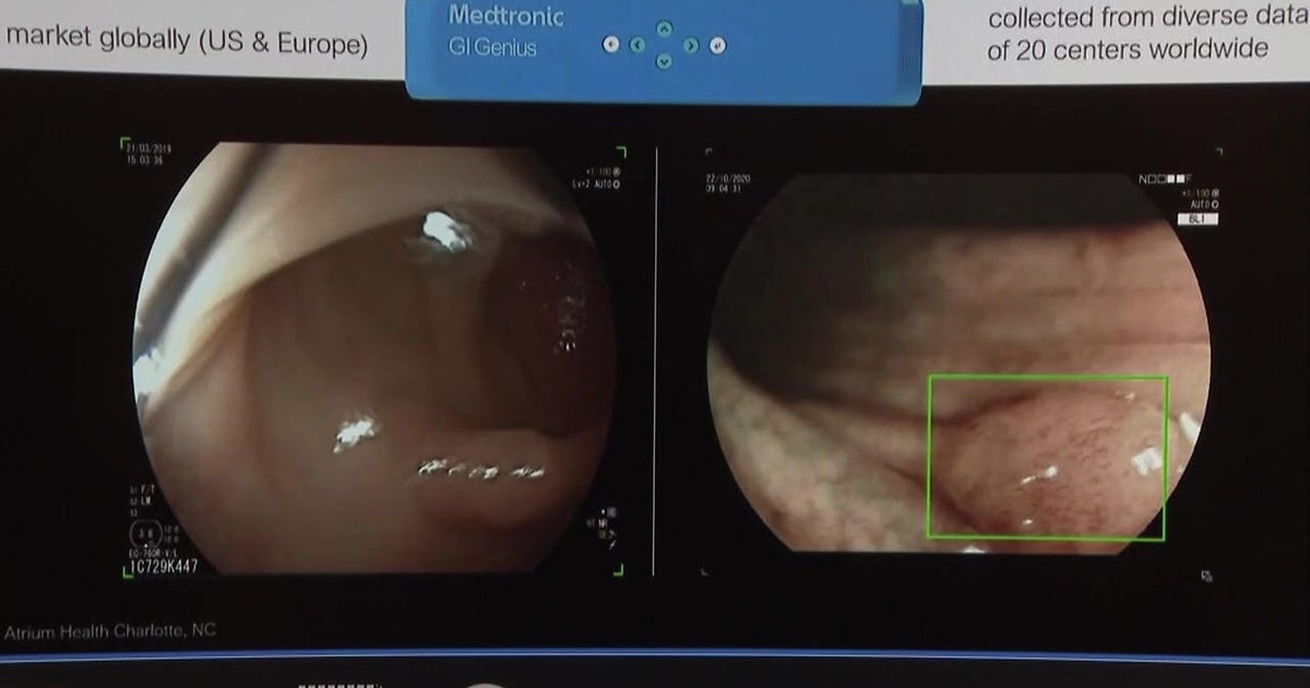 South Shore University Hospital using AI to detect polyps that can lead to colon cancer - Vimarsana News