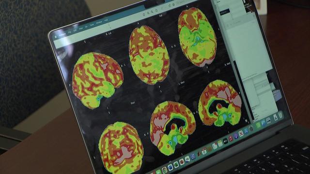 Brain scans are pulled up on a computer screen. 